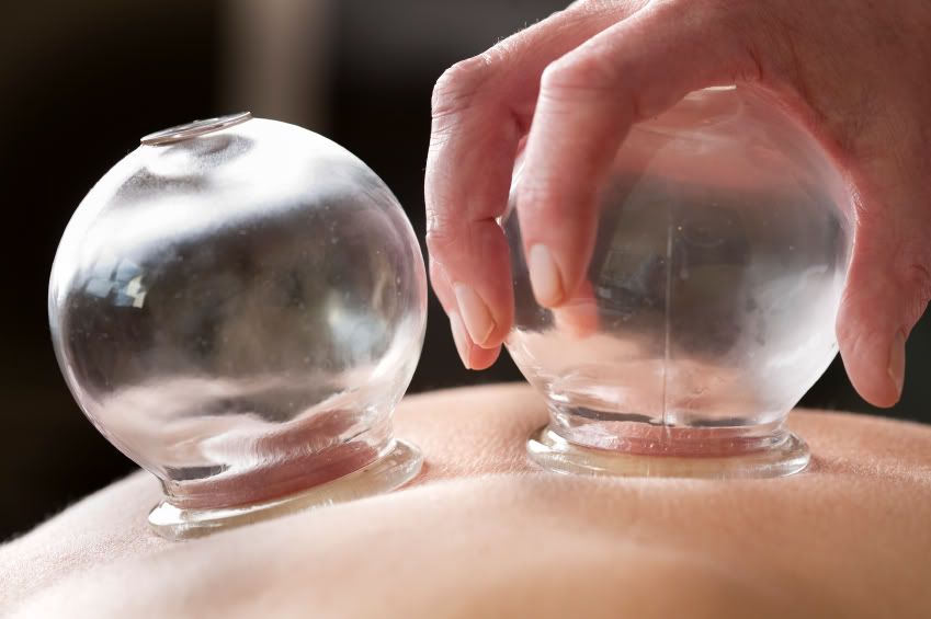 Cupping Therapy